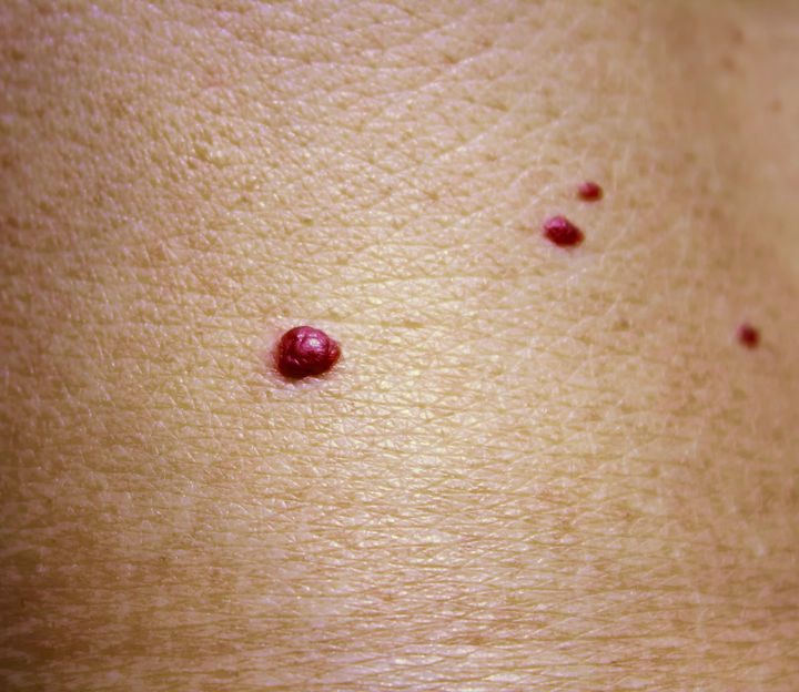 81268805 - angioma. red birthmark on the skin surface.